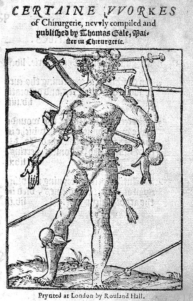 A "wound man" seen on the frontispiece of 'Certaine vvorkes of chirurgerie'.